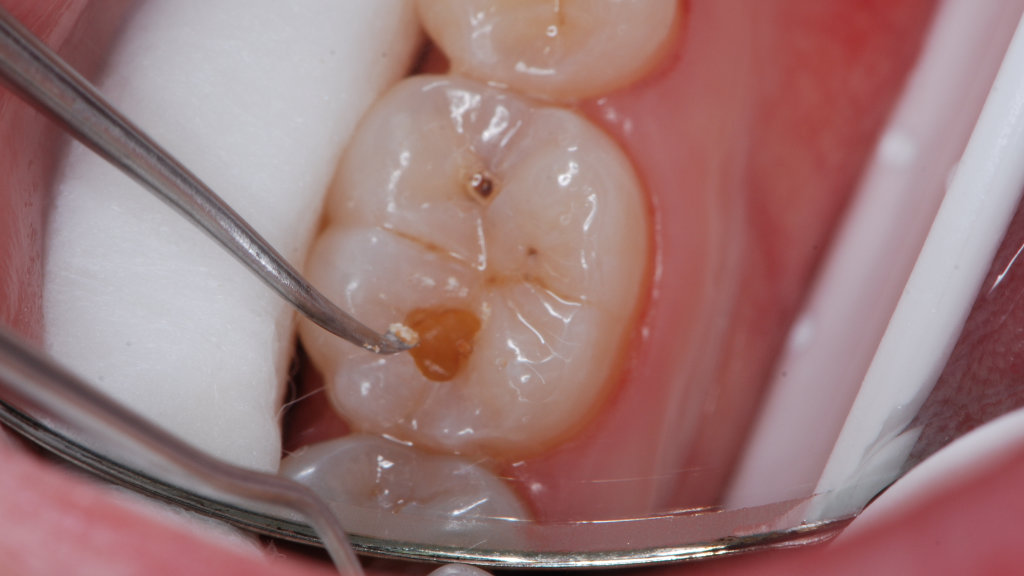 biomimetic dental fillings