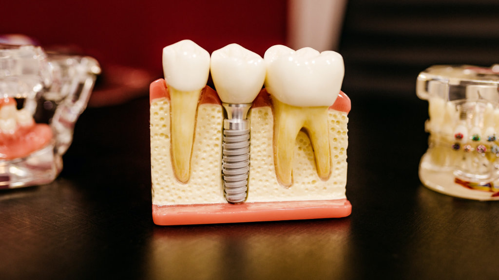 Can Biomimetic Dentistry Prevent Root Canals? Dentist Explains