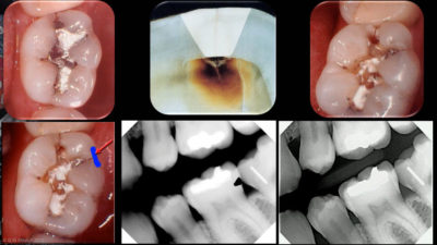 Dr. Graeme Milicich - The Six Fracture Modes of Teeth