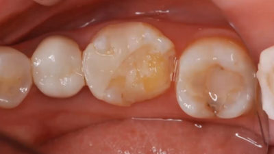 Long-Term Follow-up of Anterior and Posterior Restorations with MI Approach