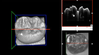 Restoration of Structurally Compromised Teeth with Direct Adhesive Technology